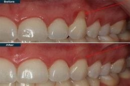 Best Gum disease treatment