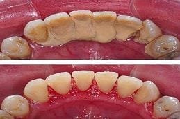Gum disease treatment in dubai