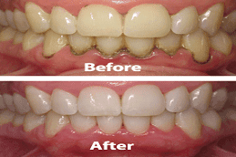 Gum disease treatment