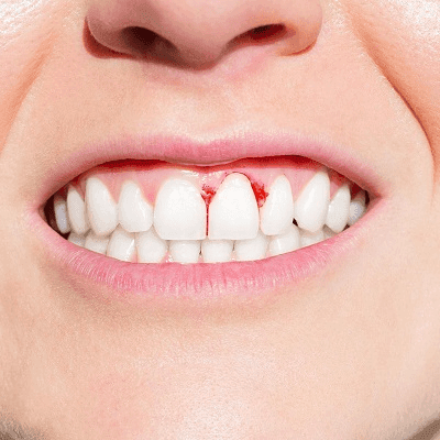 Gum Bleeding Treatment Pros and Cons in Dubai