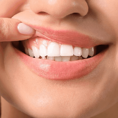 Gum Depigmentation Cost in Dubai & Abu Dhabi