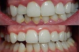Gum Recession Treatment Dubai Gum Recession Treatment Dubai