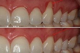 Gum Recession Treatment in Dubai & Abu Dhabi Gum Recession Treatment in Dubai & Abu Dhabi