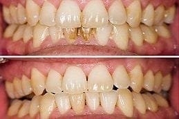 Body Contouring Treatment Gum Recession Treatment