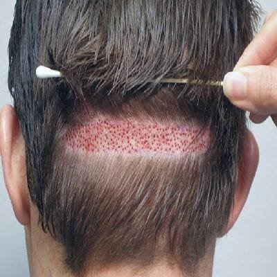 Hair Transplant Without Shaving