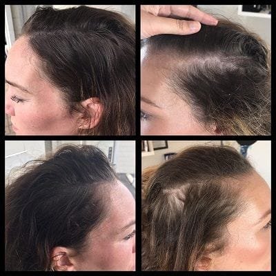 Hairline Microblading Dubai & Abu Dhabi