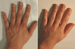 Hand Rejuvenation After and Before