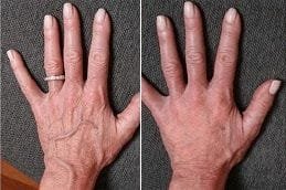 Hand Rejuvenation Before and After