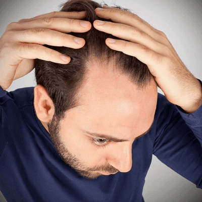 How Can I Restore My Natural Hairline In Dubai