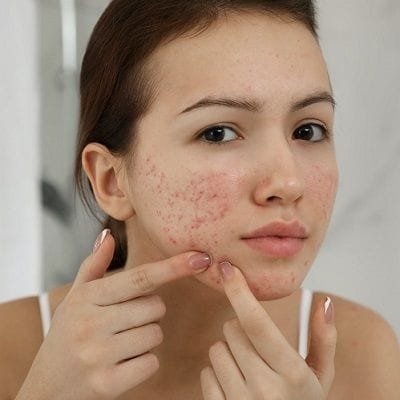 How Long Does it Take Acne Scars to Heal