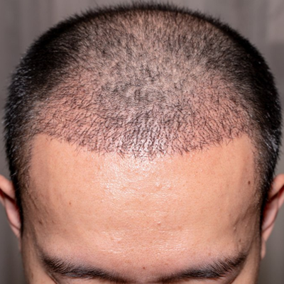 How Long Hybrid Hair Transplant Last