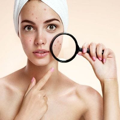 How Much Does an Acne Scars Treatment Cost?