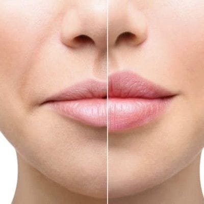 How much does it cost for lip reduction