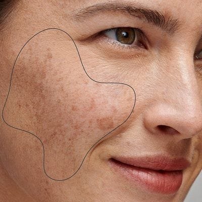 How to Maximize the Benefits of Pigmentation Treatment