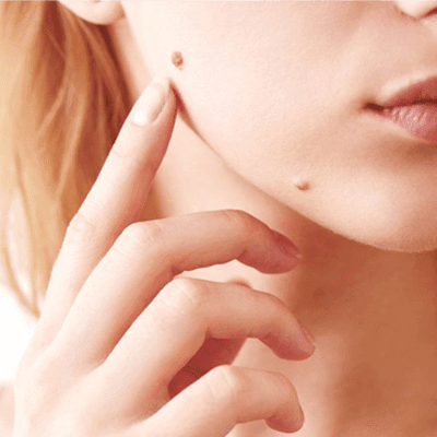 How to Permanently Get Rid of Warts?