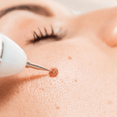 How to Remove Moles From Face Permanently