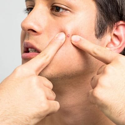 How to Remove Pimples Overnight