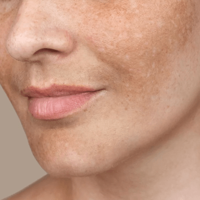 How to quickly fade hyperpigmentation?