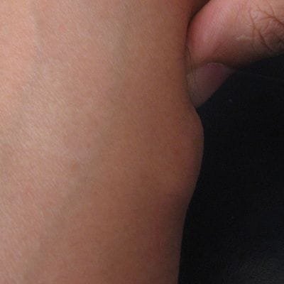 Important Facts About Lipoma Treatment in Dubai Dynamic Clinic