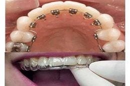 Lingual Braces 6 Invisible Lingual Braces in Dubai