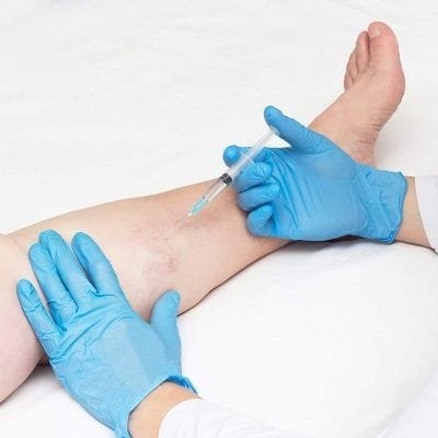 Is Sclerotherapy Permanent?