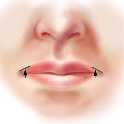 Italian Lip Lift in Dubai, Abu Dhabi & Sharjah | Prices and Deals