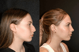 Jawline Contouring After and Before