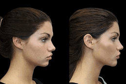Jawline Contouring 6 Jawline Contouring Before and After