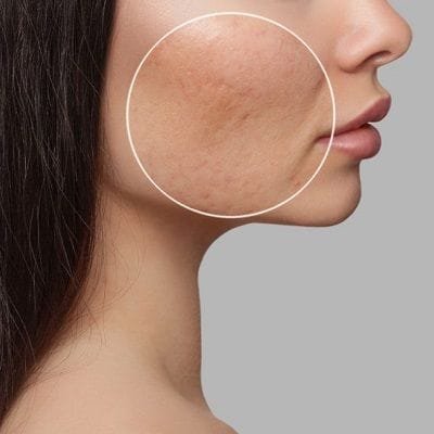 Large Pores Treatment Cost in Dubai