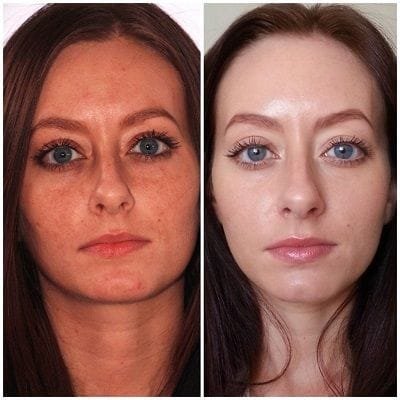 Laser Treatment for Face