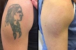 Laser Skin Treatments 6 Laser Treatments Before & After