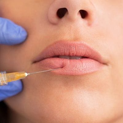 Lip filler injections in Dubai