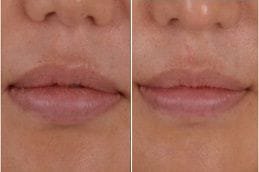 Lip Reduction 6 Lip Reduction Before and After