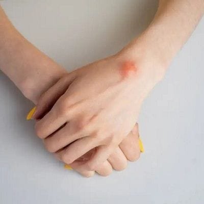 Lipoma Treatment in Dubai