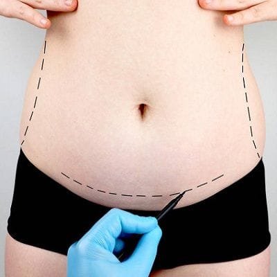 Lipomatic Treatment cost in Dubai | Lipomatic Surgery