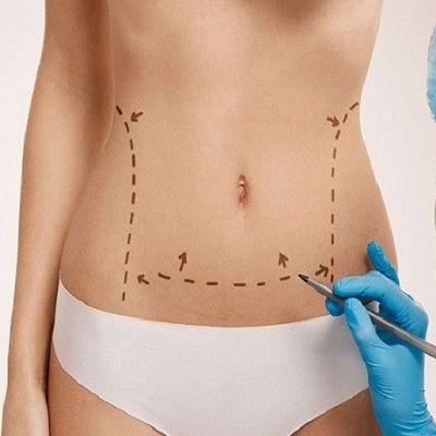 Lipomatic surgery in Dubai