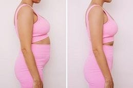 Liposuction in Silicon Oasis 4 Liposuction Before & After