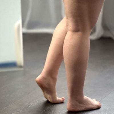 Liposuction for Lipedema