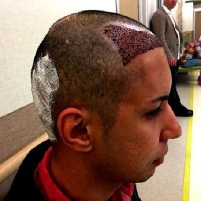 Turkish Hair Transplant