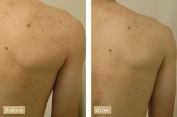 Microdermabrasion for Back Acne Dubai