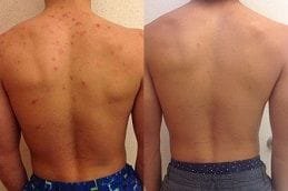 Microdermabrasion for Back Acne before & after in Dubai