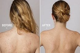 Microdermabrasion for Back Acne in Dubai
