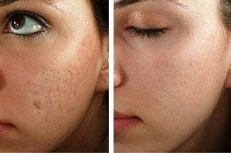 Microdermabrasion for Face Acne Dubai