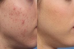 Microdermabrasion for Face Acne before & after in Dubai