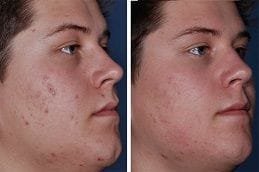 Microdermabrasion for Face Acne in Dubai
