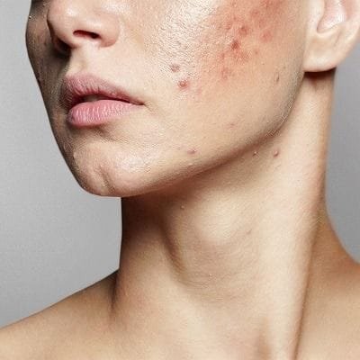 Minimize Acne Scars And Boost Confidence