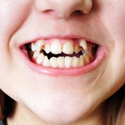 Dental Space Maintainers for Children