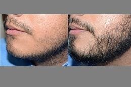 Mustache Hair Transplant in Dubai 6 Mustache Hair Transplant Before & After