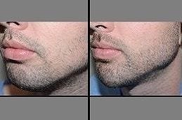 Mustache Hair Transplant in Dubai 5 Mustache Hair Transplant in Dubai Before & After