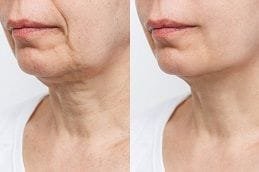 Nefertiti Lift in Dubai Before and After